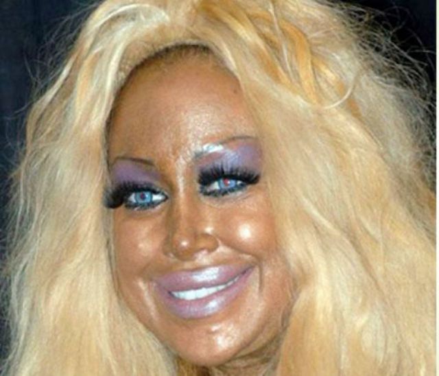 More-plastic-surgery-disasters20